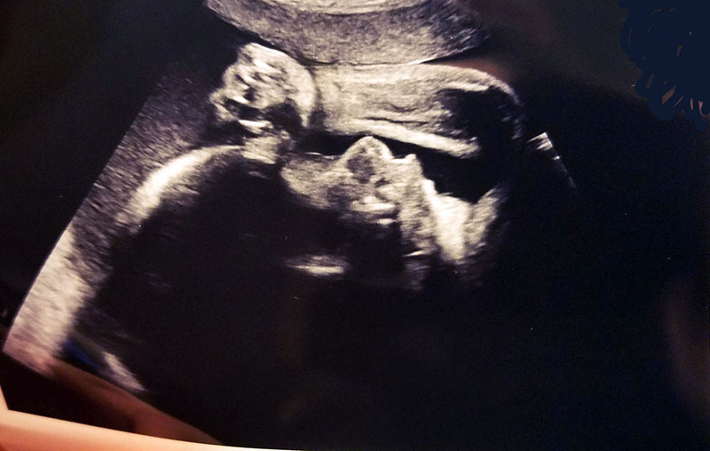 baby dime sonogram